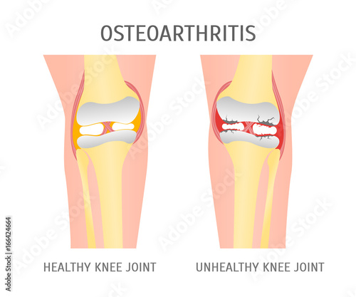 Cartoon Osteoarthritis Healthy and Unhealthy Knee. Vector