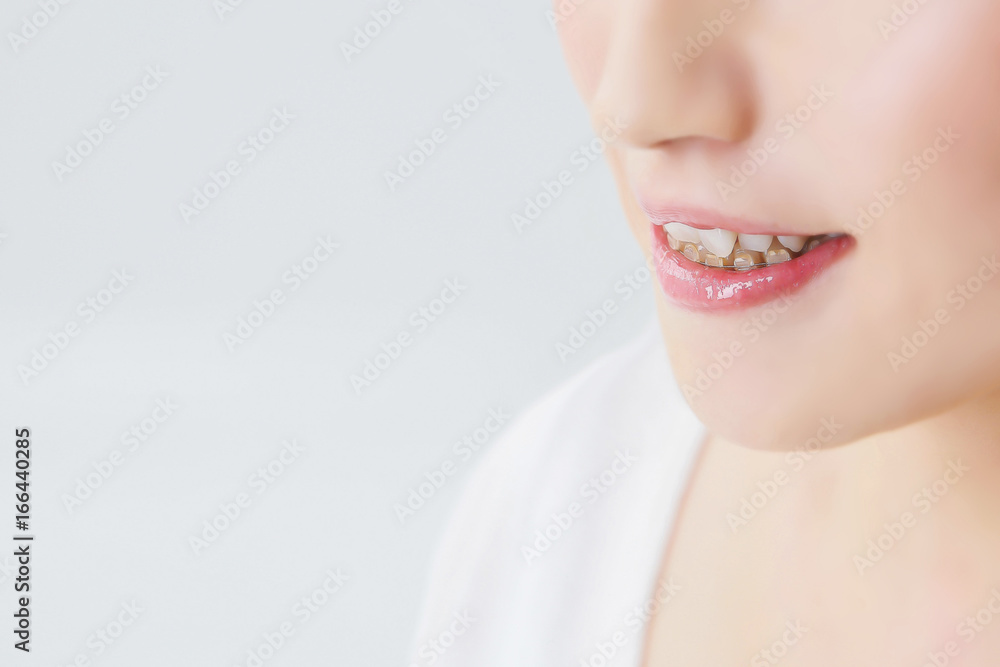 Obraz premium 歯列矯正している歯 