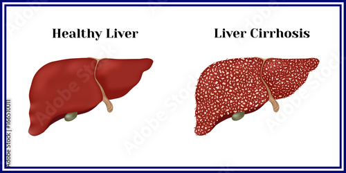 Healthy liver and cirrhosis.