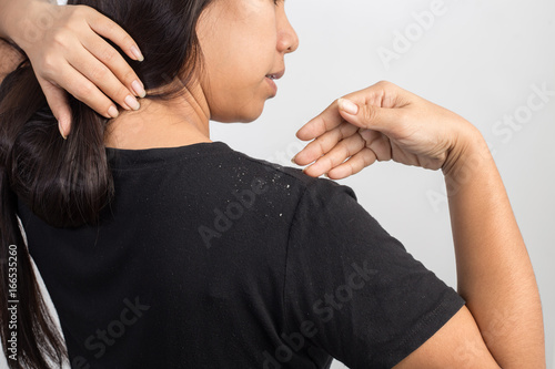 Принти на полотні women having dandruff in the hair and shoulder