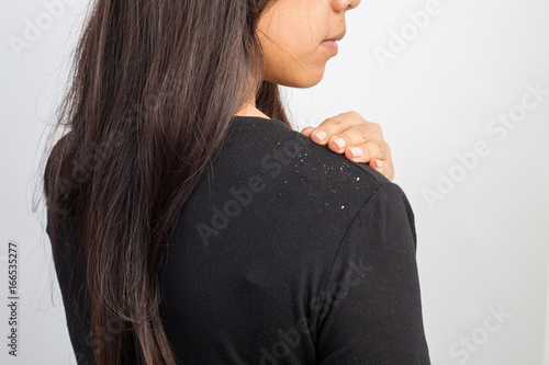 women having dandruff in the hair and shoulder photo