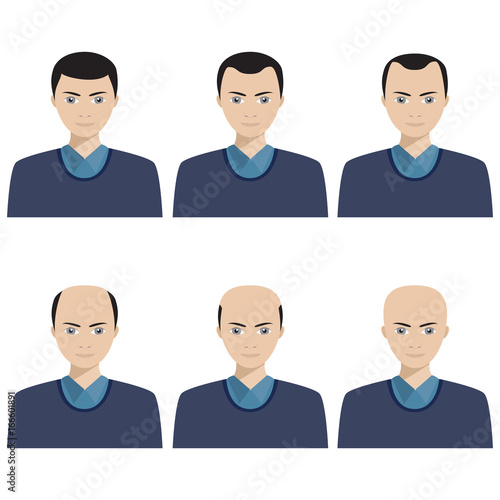 Hair loss stages and types of baldness.