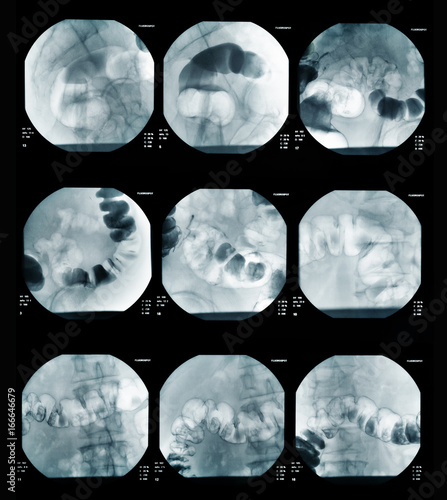 ntestinal abdominal xray