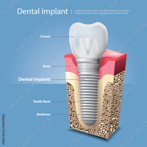 Human teeth and Dental implant Vector Illustration