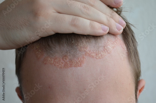 Psoriasis on the skin close-up, scalp, photos of dermatitis and eczema, skin problems, dermatology