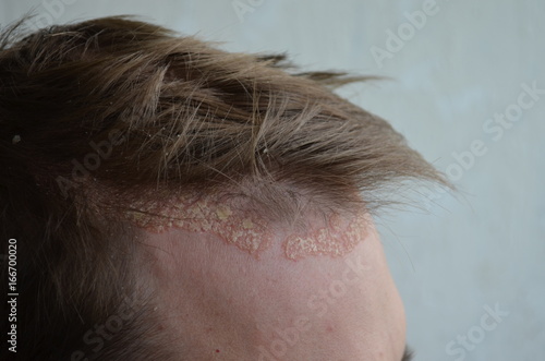 Psoriasis on the skin close-up, scalp, photos of dermatitis and eczema, skin problems, dermatology