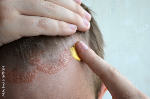 Anoint with cream, ointment, medicine forehead, hair line, scalp with psoriasis, dermatitis, problem skin, eczema, dermatology