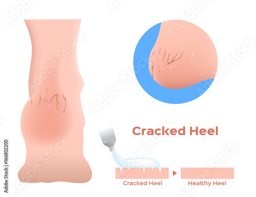 cracked heels and a medicine apply on it . vector