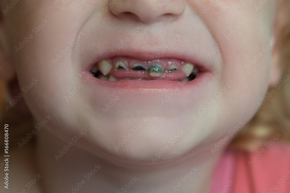 Naklejka premium Not healthy baby's front teeth with black caries