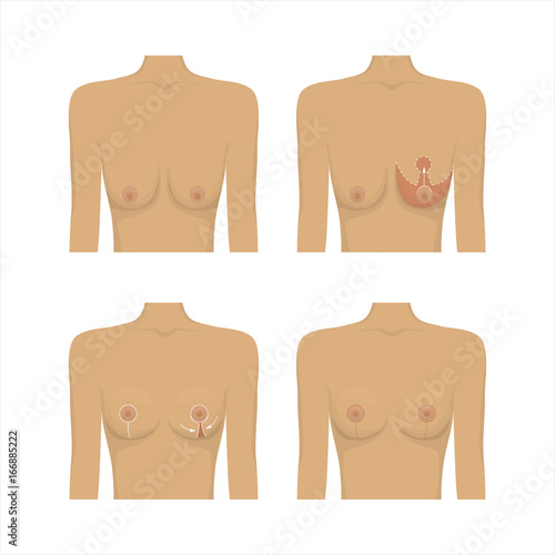 Lifting breast plastic surgery. Cosmetic procedure of mastopexy, technique and method. Female healthcare concept. Medical clinic poster. White background vector illustration