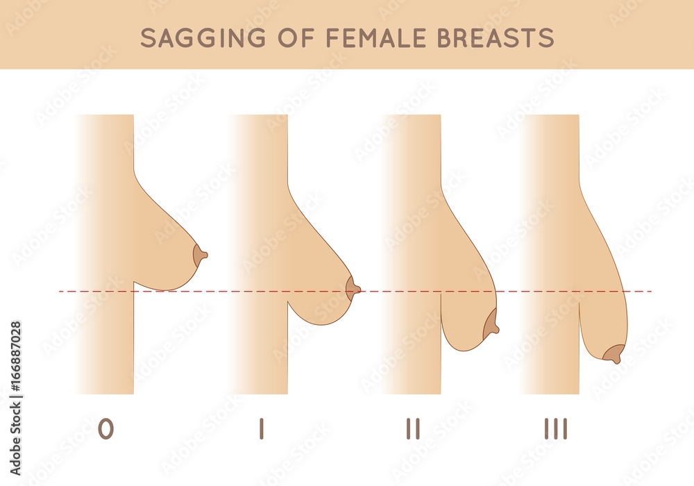 Female breast sagging. Health promotion and education for women