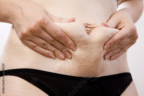 the girl shows the scar after cesarean section. the abdomen after pregnancy and childbirth
