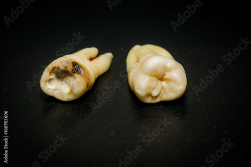 Tooth After Extraction
