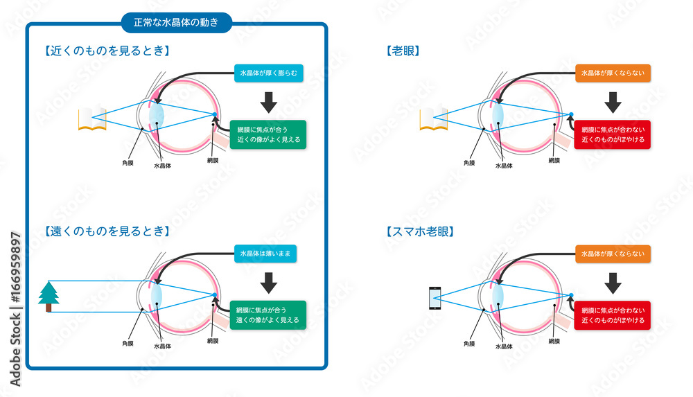 老眼 スマホ老眼の図解ベクターイラスト Stock Vector Adobe Stock