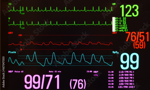Monitor with a black background showing atrial flutter on the green ECG lines, arterial blood pressure on the red line, noninvasive blood pressure in purple and oxygen saturation on the blue line.  photo