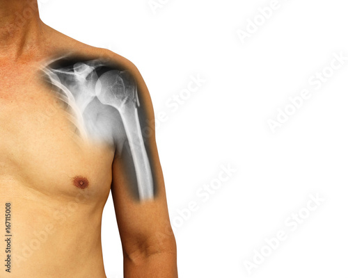 Human shoulder with x-ray show fracture at neck of humerus ( Arm bone ) . Isolated background . Blank area at right side