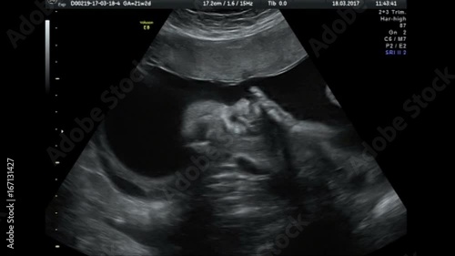 Ultrasound baby 22 weeks
