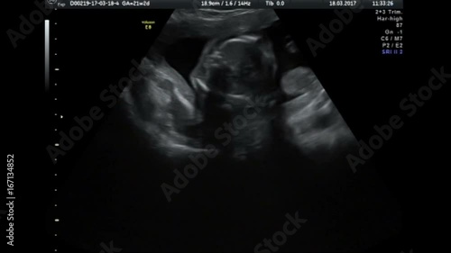Ultrasound baby 22 weeks