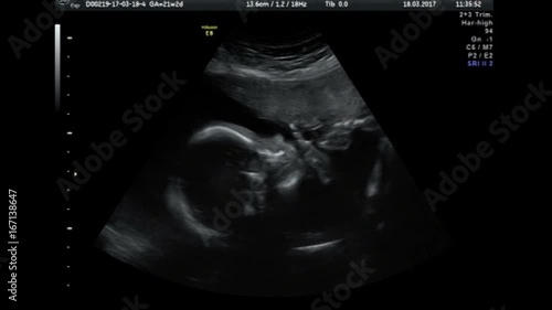 Ultrasound baby 22 weeks