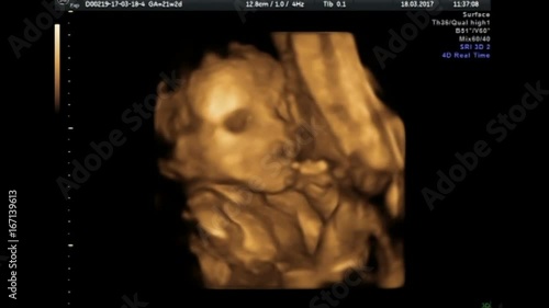 Ultrasound baby 22 weeks