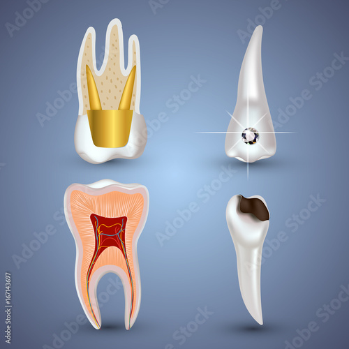 Vector set of 3d realistic clean and dirty tooth isolated on gray background. Dental health Concept. Oral Care, teeth restoration