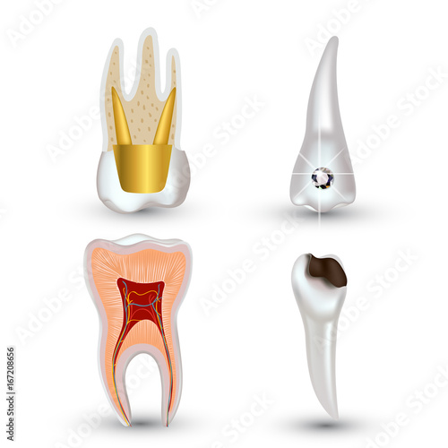 Vector set of 3d realistic clean and dirty tooth isolated on white background. Dental health Concept. Oral Care, teeth restoration
