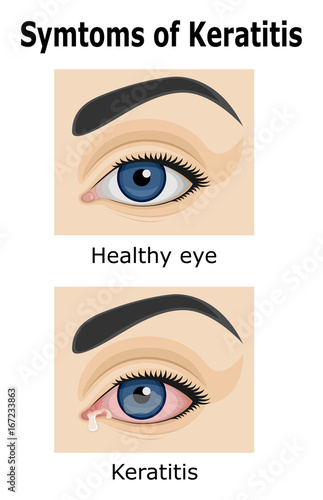 Illustration of Keratitis
