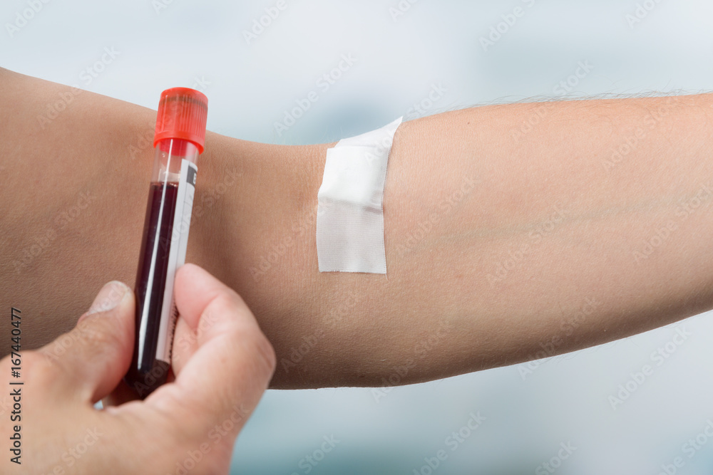 Nach der Blutentnahme Hand mit Blutprobe und Arm mit Pflaster StockFoto Adobe Stock