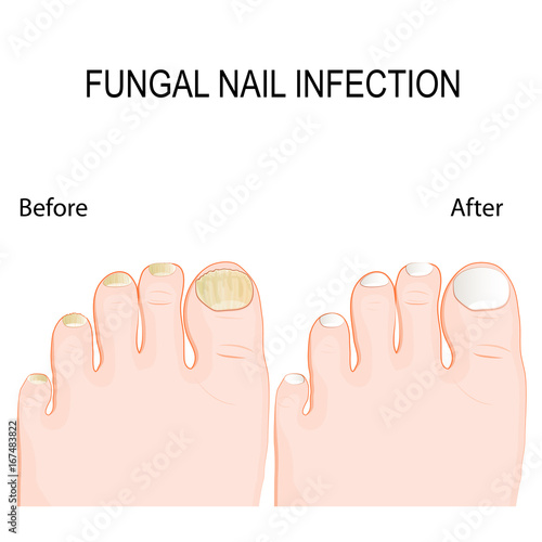 fungal nail infection. Before and after Renewal Treatment.