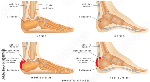 Heel Bursitis