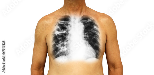 Pulmonary tuberculosis . Human chest with x-ray show cavity at right upper lung and interstitial infiltrate both lung due to infection . Isolated background photo