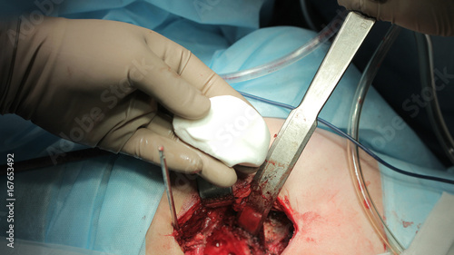 Surgeon holds cement during the hip replacement close up photo