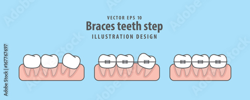 Braces teeth step illustration vector on blue background. Dental concept.