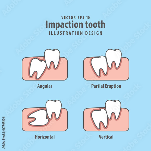 Impaction tooth illustration vector on blue background. Dental concept.