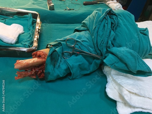 Amputation surgery