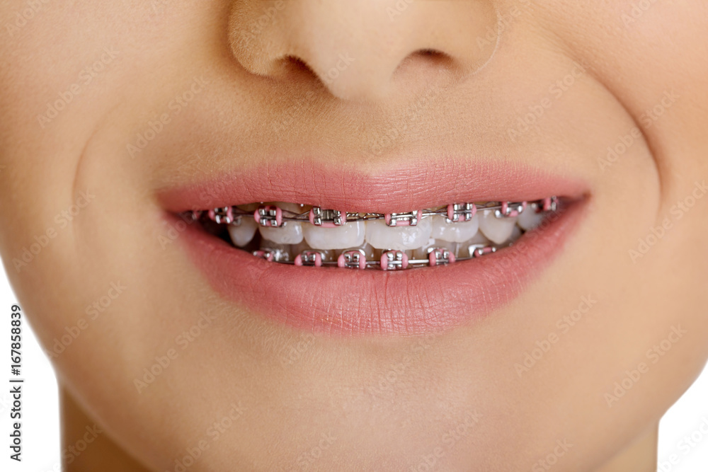 Fototapeta premium Smile with dental braces.