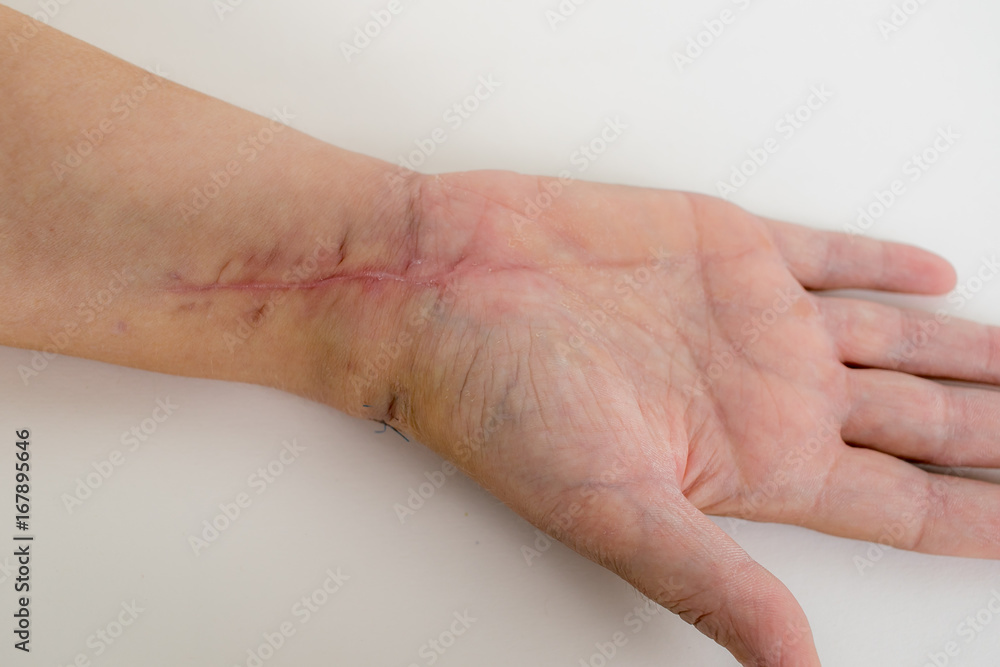 Fototapeta premium Narben am Handgelenk, Radiusfraktur