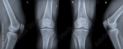 Röntgenbild Kniegelenk photo