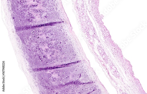 Canvas Print Histology of human tissue, show tracheitis and squamous metaplasia of bronchial