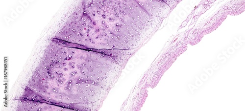 Histology of human tissue, show tracheitis as seen under the microscope photo