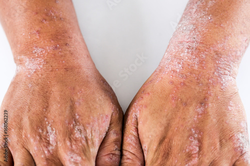 Atopic dermatitis (AD), also known as atopic eczema, is a type of inflammation of the skin (dermatitis). photo
