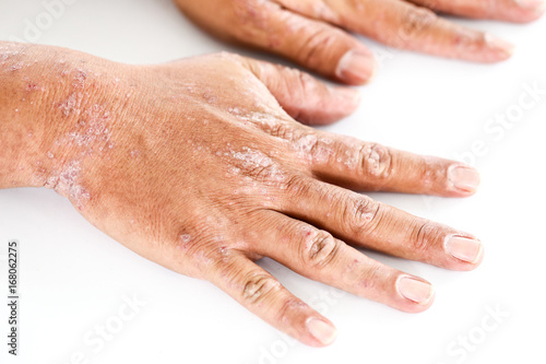 Atopic dermatitis (AD), also known as atopic eczema, is a type of inflammation of the skin (dermatitis). photo