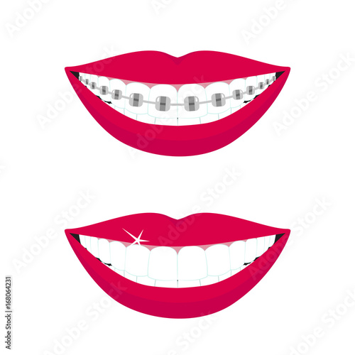 Beautiful smiling mouth with braces on teeth before and after. Design concept. Vector illustration
