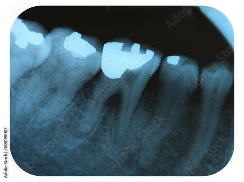 Foto X-Ray Negative Tooth Filling Amalgam