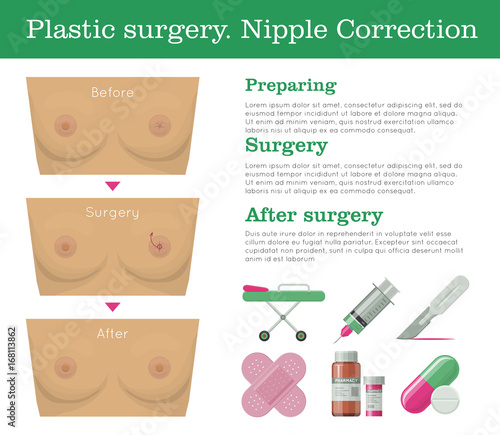 Plastic surgery nipple correction infographic. Scheme of surgical nipple reconstruction before and after and medical equipment. Teat inverted restoration in the form of a vector illustration
