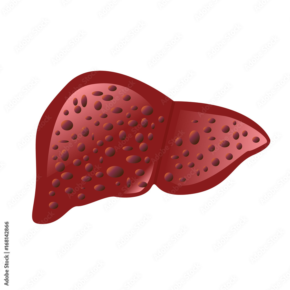 Liver affected by cirrhosis Liver affected by cirrhosis