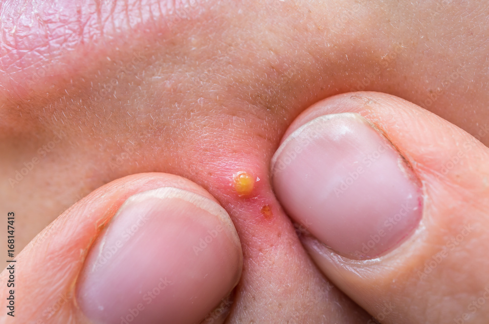 Woman squeezing pimple with two fingers on her face Woman squeezing pimple with two fingers on her face