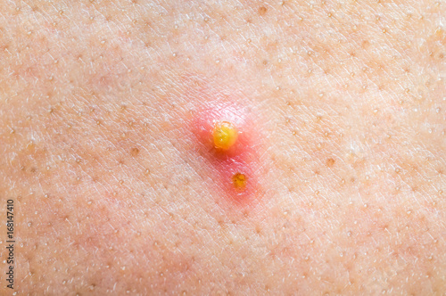 Tableau sur toile Close-up photo of pimple or acne on face