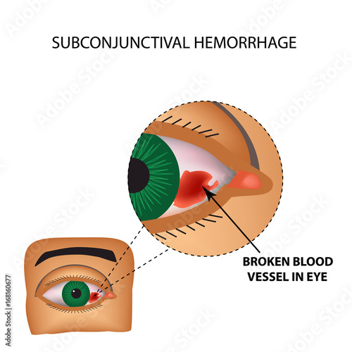 The vessel in the eye burst. Inflammation and redness. The structure of the eye. Infographics. Vector illustration on isolated background