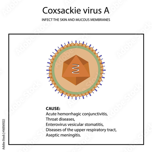 The structure of Coxsackie Virus A. Symptoms of the disease. Enterovirus. Infographics. Vector illustration on isolated background